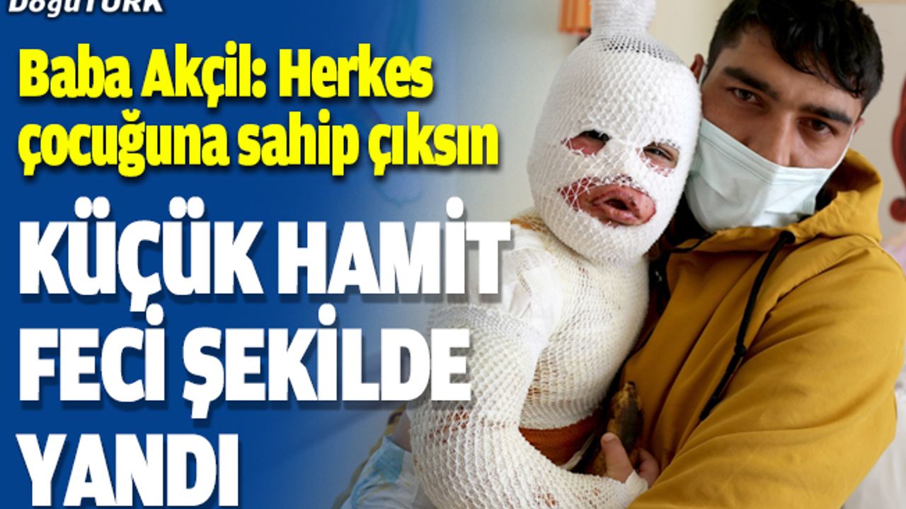 Başından aşağı kaynar su dökülen çocuk Erzurum'da tedaviye alındı